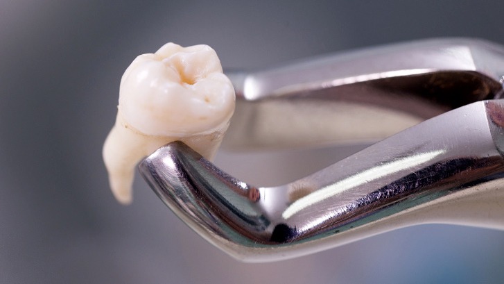 Lost Tooth Blog Lost Tooth Dublin | 24 hour Emergency Dentist Near Me | 7DayDentist