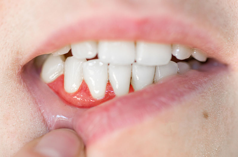 Dental Abscess